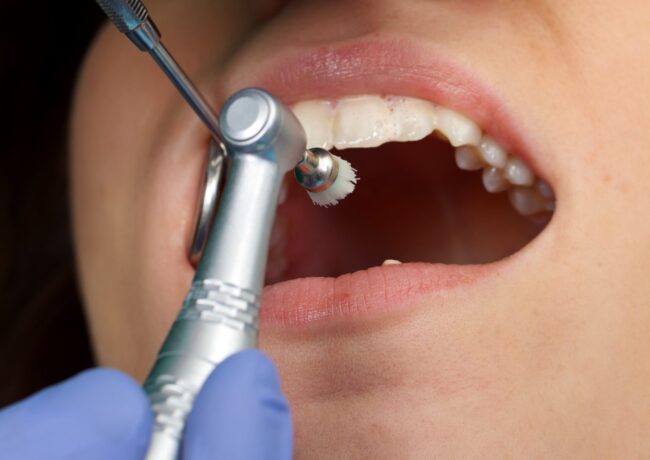 Mercury-Free Dentistry